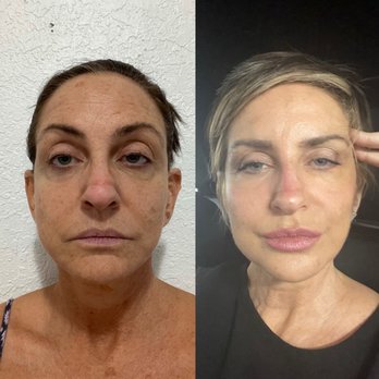 Get Refreshed - No surgery involved. Amazing. - Medical Spas Near Me - Miami, Florida