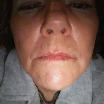 Advanced Aesthetics - After fillers - Medical Spas Near Me - Las Vegas, Nevada