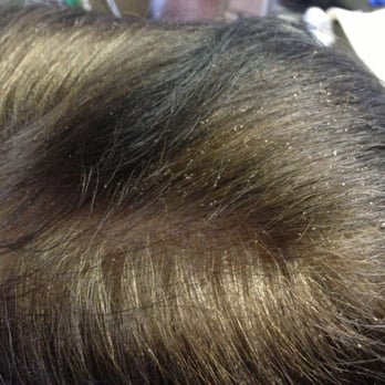 Head Lice Infestation Nits With Real Hair Extensions Yelp