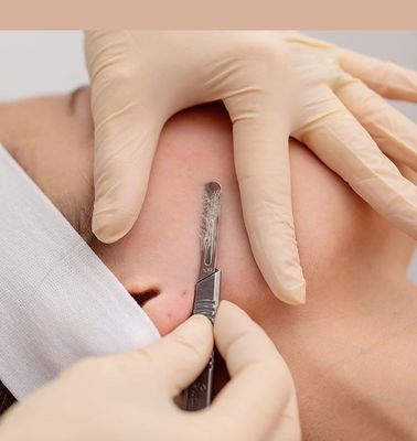 Dermaplaning Treatment - A precise exfoliation, no more peach fuzz, just smooth healthy skin. Call to book today! Dermaplaning Treatment - A precise exfoliation, no more peach fuzz, just smooth healthy skin. Call to book today!