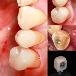 Smile Design Burbank - Final all ceramic crown made in 2 hours. No temporaries. No second appointments.