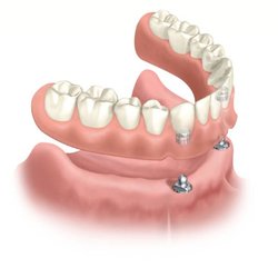 Premier Dental Center - Overdentures are replacement teeth retained by dental implants. The improved stability allows you to chew food more thoroughly no adhesives.