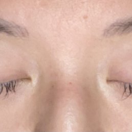 5 weeks after first retouch. Eyelids are red from season allergies. 5 weeks after first retouch. Eyelids are red from season allergies.