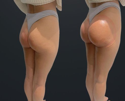 Targeted Sculpt - Fat elimination, contour, smooth, and tighten 1 area