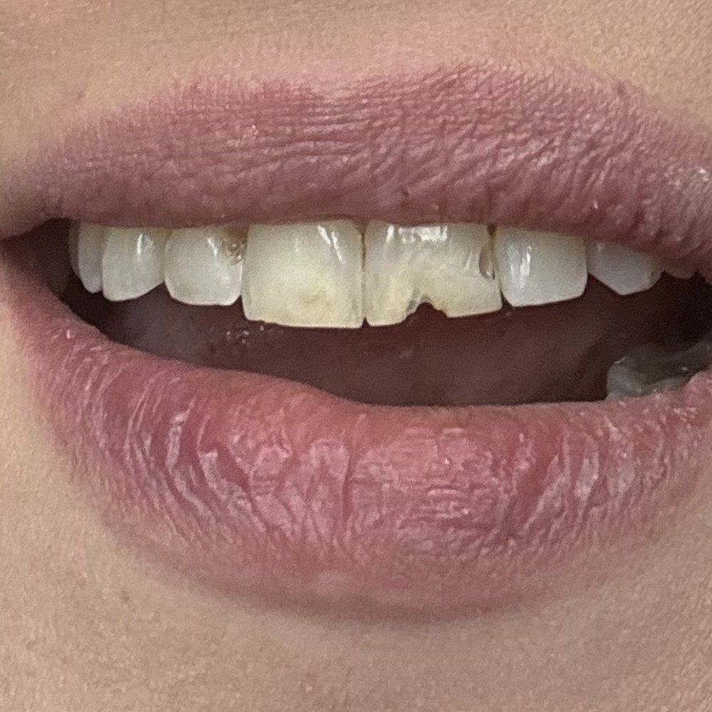 Brookshire Dentistry - Before picture of my teeth! - General Dentistry Near Me - Hurst, Texas Brookshire Dentistry - Before picture of my teeth! - General Dentistry Near Me - Hurst, Texas
