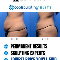 Skin Perfect Medical Aesthetics - CoolSculpting Elite Results