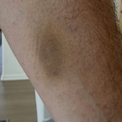 Saxon Surgical Center - A smaller needle did this! Ha.