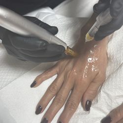 Dermalaser Med Spa - PRP (platelet rich plasma) for hand rejuvenation
