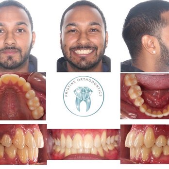 Pristine Orthodontics - After - Orthodontists Near Me - Mountain View, California