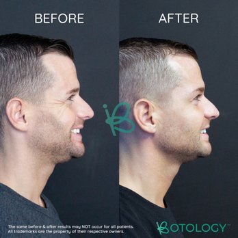 Botology - Botox Specialist - My crows feet are gone! - Medical Spas Near Me - Irvine, California Botology - Botox Specialist - My crows feet are gone! - Medical Spas Near Me - Irvine, California