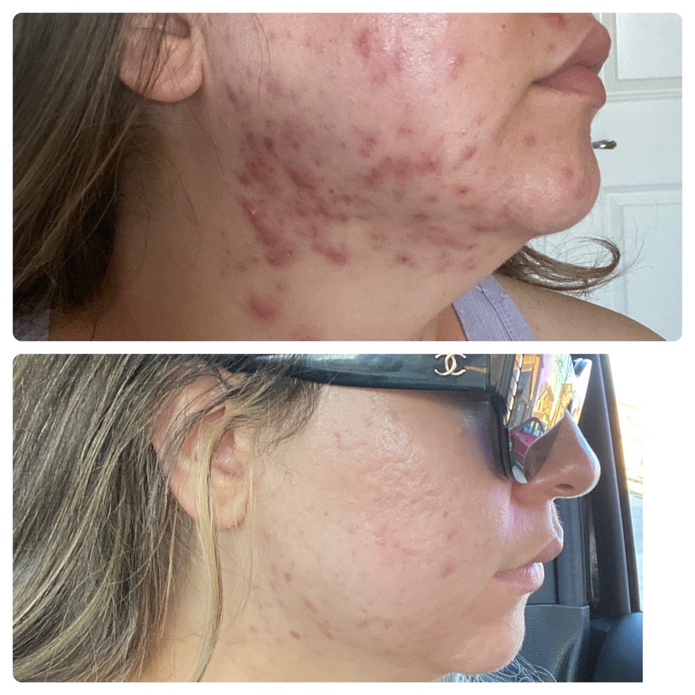 Ethereal Day Spa - 2.5 months treated by dermatologist (top) vs. 2.5 months with Hilda (bottom) - Skin Care Near Me - Temecula, California
