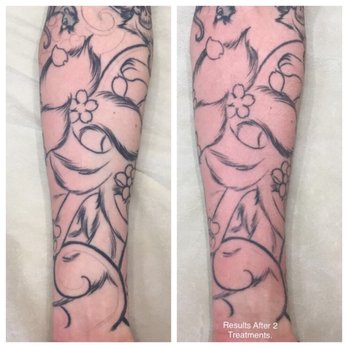 Removery Tattoo Removal & Fading - Before any sessions on the left - Tattoo Removal Near Me - Denver, Colorado
