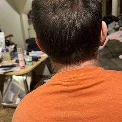Bosley Hair Restoration & Transplant - Bosley Hair transplant,