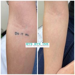 Bye Bye Ink - Before and after 7 sessions