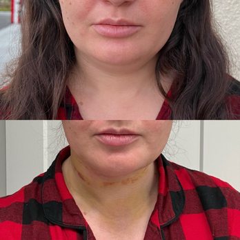 Brandyn Dunn MD - Morning of surgery vs. day 2 - Plastic Surgeons Near Me - Newport Beach, California Brandyn Dunn MD - Morning of surgery vs. day 2 - Plastic Surgeons Near Me - Newport Beach, California