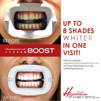 Chester Linebarier DDS - Before and after whitening treatment using Opalescence Boost - Dentists Near Me - Germantown, Tennessee Chester Linebarier DDS - Before and after whitening treatment using Opalescence Boost - Dentists Near Me - Germantown, Tennessee