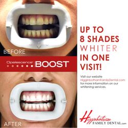 Chester Linebarier DDS - Before and after whitening treatment using Opalescence Boost