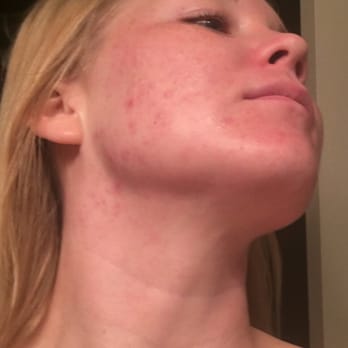 Zara Med Spa - This is 6 treatments in, loving my results ! Such a difference! - Skin Care Near Me - Chula Vista, California Zara Med Spa - This is 6 treatments in, loving my results ! Such a difference! - Skin Care Near Me - Chula Vista, California