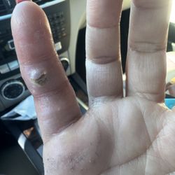Monrovia Internal Medicine and Primary Care - Dog bite