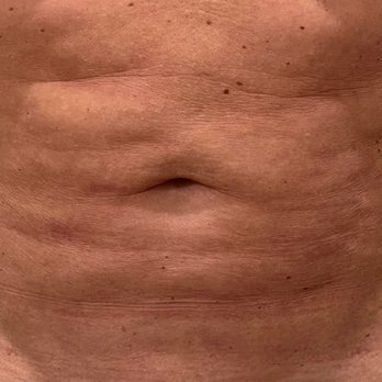 Infini Cosmetic Associates - One year after - Cosmetic Surgeons Near Me - Scottsdale, Arizona