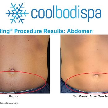 Coolbodispa - Body Contouring Near Me - Norman, Oklahoma