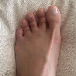 John DelMonte, DPM - Del Monte Podiatry - Left foot after surgery