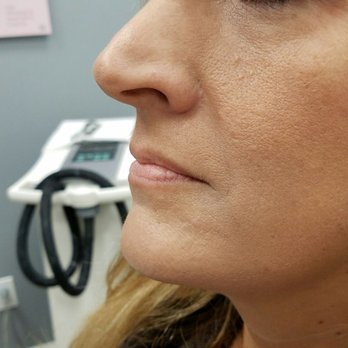 LaserAway - Before - Laser Hair Removal Near Me - Temecula, California LaserAway - Before - Laser Hair Removal Near Me - Temecula, California