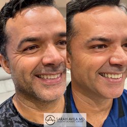 Sarah Avila, MD - Botox to crows feet