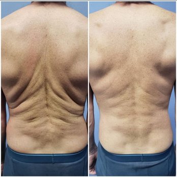 Lauren Keller Structural Integration - Before and after session three of Structural Integration ten series. - Massage Therapy Near Me - San Diego, California Lauren Keller Structural Integration - Before and after session three of Structural Integration ten series. - Massage Therapy Near Me - San Diego, California