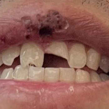 El Segundo Modern Dentistry - Damaged car accident caused my front teeth - General Dentistry Near Me - El Segundo, California El Segundo Modern Dentistry - Damaged car accident caused my front teeth - General Dentistry Near Me - El Segundo, California