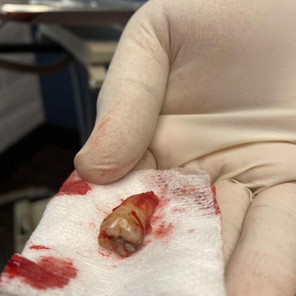 Tooth extraction Took 5 mns!