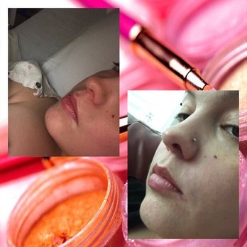 VIDA Aesthetic Medicine - Photos on the left / top are the before s. Photos on the right are afters. - Medical Spas Near Me - Salem, Oregon VIDA Aesthetic Medicine - Photos on the left / top are the before s. Photos on the right are afters. - Medical Spas Near Me - Salem, Oregon