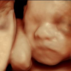 Hey Baby 3D4D Ultrasound - 3D ultrasound