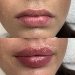 Hyaluron Lip treatment