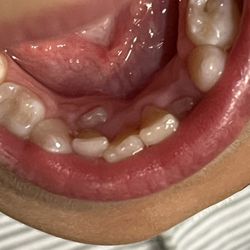 Drs May & Bessma Hayder, Pediatric Dentistry - Trapped baby tooth between three adult teeth