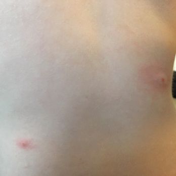 Great Wolf Lodge - Bug bite marks - Resorts Near Me - Grapevine, Texas Great Wolf Lodge - Bug bite marks - Resorts Near Me - Grapevine, Texas