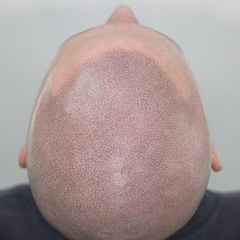 Magic Ink SMP - Hair Loss Centers Near Me - Winnetka, Illinois Magic Ink SMP - Hair Loss Centers Near Me - Winnetka, Illinois