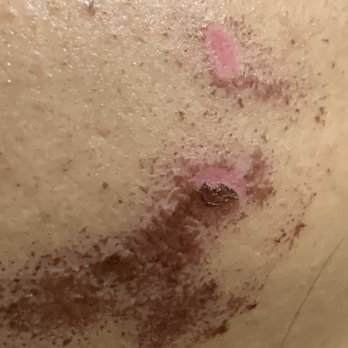 Laser Sculpture - Botched facial - Medical Spas Near Me - Torrance, California Laser Sculpture - Botched facial - Medical Spas Near Me - Torrance, California