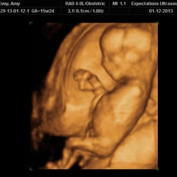 Expectations Ultrasound - 16 weeks