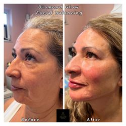 Aguilar Aesthetics Medspa & Wellness - Diamond Glow Facial Balancing Treatment at Aguilar Aesthetics Medspa & Wellness in Aventura, FL