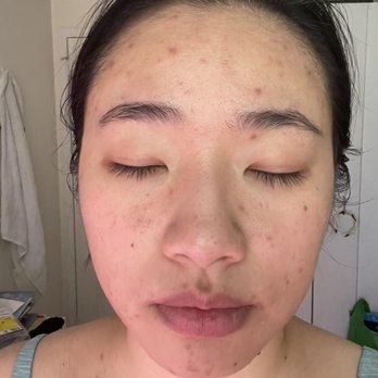 Kelly's Beauty - May 2022 - 1 Month after treatment - Skin Care Near Me - Boston, Massachusetts Kelly's Beauty - May 2022 - 1 Month after treatment - Skin Care Near Me - Boston, Massachusetts