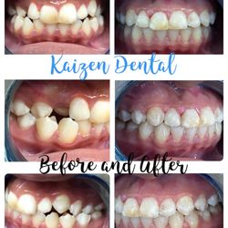 Kaizen Dental - Delayed eruption/impaction
Orthodontic treatment with guided surgical eruption
