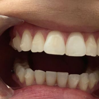 Damas M John, DDS - Chipped teeth. Save your money - Orthodontists Near Me - Orland Park, Illinois Damas M John, DDS - Chipped teeth. Save your money - Orthodontists Near Me - Orland Park, Illinois