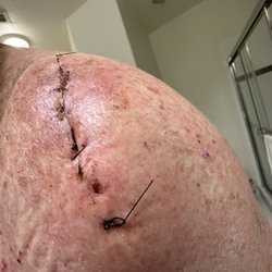 Iconic Health & Hyperbarics - 8 days after resection surgery for left shoulder