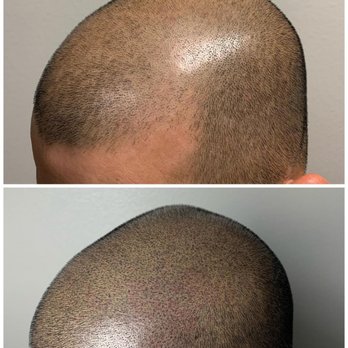 1. LV Scalp King