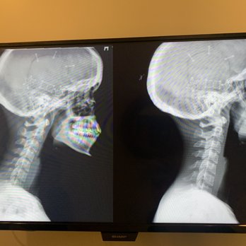 In8 Love Wellness - Comparing my old bad straight neck to my new & improved curve - Chiropractors Near Me - Los Angeles, California In8 Love Wellness - Comparing my old bad straight neck to my new & improved curve - Chiropractors Near Me - Los Angeles, California