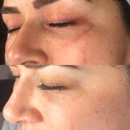 Results - deep brown spots and scars w take multiple sessions to conceal. Results - deep brown spots and scars w take multiple sessions to conceal.