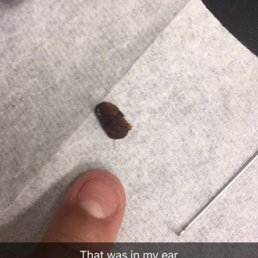 Ear wax buildup Ear wax buildup