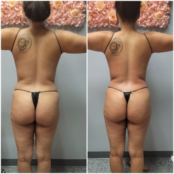 Body Bliss LV - Befor and After: One session of Non-invasive Laser Lipo to the upper and lower back and love-handles. - Medical Spas Near Me - Las Vegas, Nevada Body Bliss LV - Befor and After: One session of Non-invasive Laser Lipo to the upper and lower back and love-handles. - Medical Spas Near Me - Las Vegas, Nevada