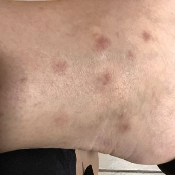 Lyngate Park - Noseeum/Sand flea bites. Very painful - Dog Parks Near Me - Port St. Lucie, Florida Lyngate Park - Noseeum/Sand flea bites. Very painful - Dog Parks Near Me - Port St. Lucie, Florida